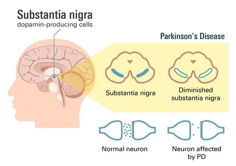 Parkinson's Symptoms & Management