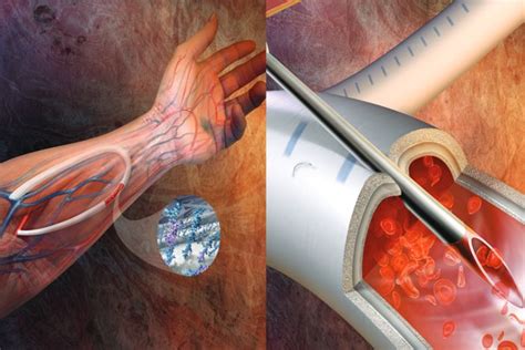 Vascular Grafts Market Size, Trends, Shares, Insights and Forecast - 2026 | Grafting, Vascular ...