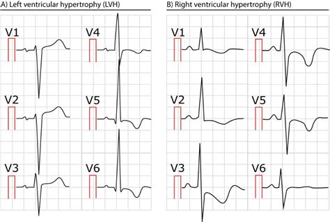 ECG in left ventricular hypertrophy (LVH): criteria and implications – ECG & ECHO | Medical ...