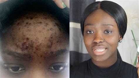 HOW TO : CLEAR ACNE ON A BUDGET!!!(Real Life, Quick Results) - YouTube