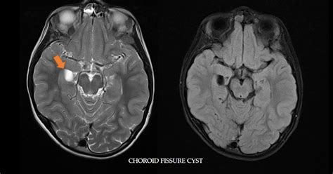 Ultimate Radiology : Choroid Fissure Cyst