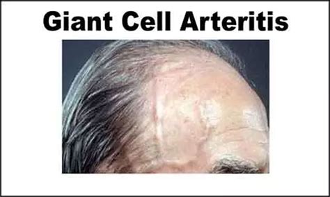 Diagnosis and treatment of giant cell arteritis: BSR guidelines