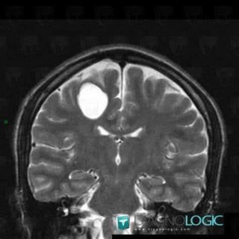 Radiology case : Neuroglial cyst (MRI) - Diagnologic