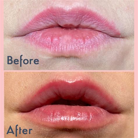 LipMD lip plumper gloss review: Before and after photos - mamabella