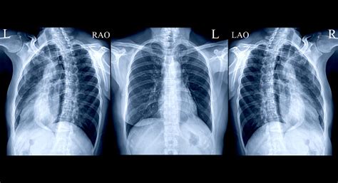 Collection Chest Xray Or Xray Image Of Human Ap And Both Oblique View For Detect Fracture Rib ...