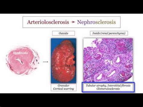 12DaysinMarch, Blood Pressure IV, Hypertensive Nephrosclerosis for the USMLE Step One Exam - YouTube