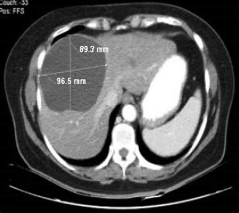 Liver cyst causes, symptoms, diagnosis & treatment