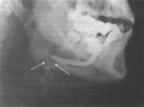 Sialogram showing a salivary stone (marked by arrows) localised in the ...