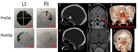 Cureus | Do Not Give Up on Ossified Tuberculum Sellae Meningioma ...