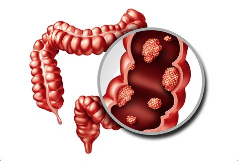 Colon Cancer Screening: Who Should Get Screened & How