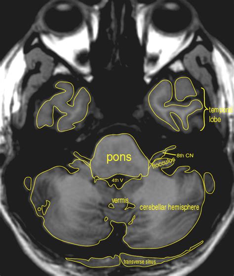 MRI Atlas: Brain (Axial) - Scan 2 - Labeled (Enlarged) | Eccles Health ...