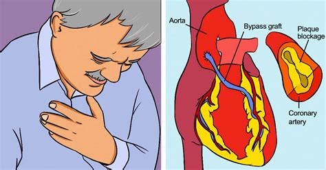 Coronary Artery Disease: Causes, Symptoms and Treatment Options | Healthtian