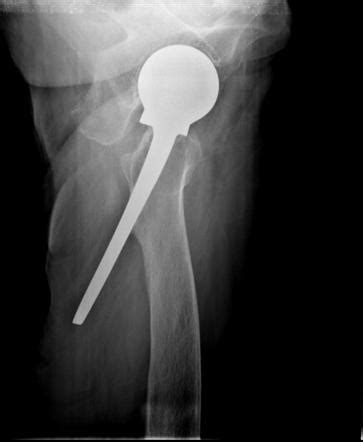 Complications of total hip arthroplasty | Radiology Reference Article | Radiopaedia.org