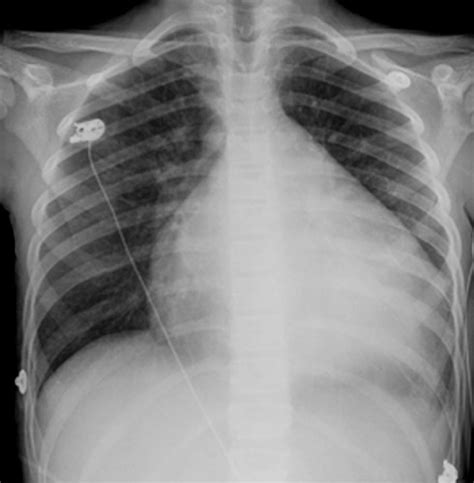 X-Rays of the Chest - Heart and Blood Vessel Disorders - MSD Manual ...