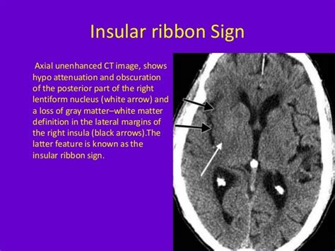 Imaging in acute stroke