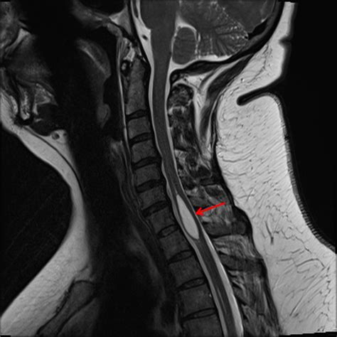 CaseStacks.com - Neuroradiology MRI Case #22