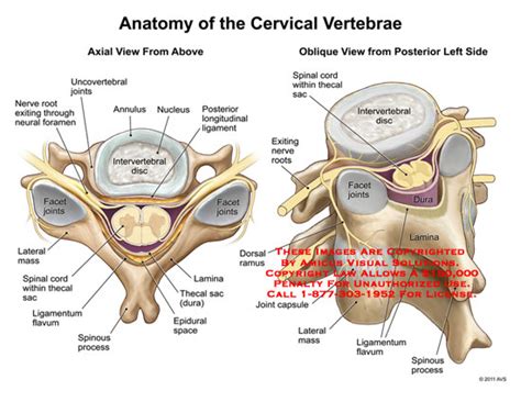 AMICUS Illustration of amicus,anatomy,cervical,vertebrae,nerve,roots,neural,foramen,facet,joints ...