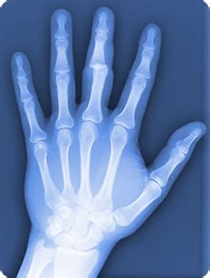 Dislocated Finger | London Hand Surgeon