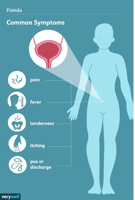 Perineal Fistula Symptoms