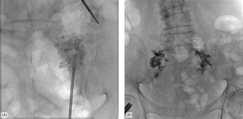 Percutaneous Sacroplasty | Anesthesia Key