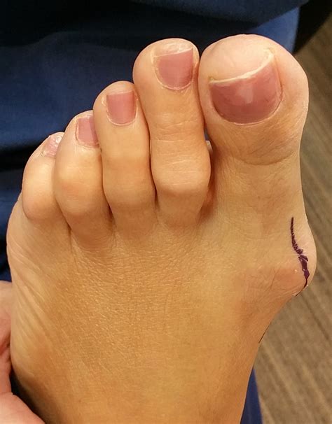 Surgical Correction of Bunions | Podiatric Surgery Centre