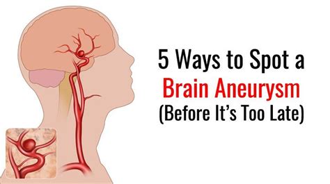 5 Ways to Spot a Brain Aneurysm | Brain aneurysm, Aneurysm, Brain surgery