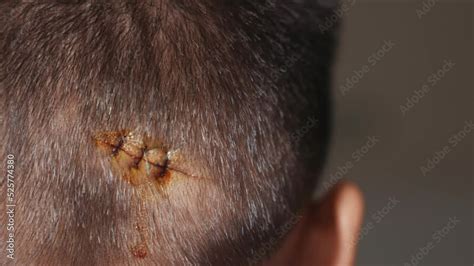 The lacerated sutured wound of kid back head which suture by nylon suture about 3 stitches at ...