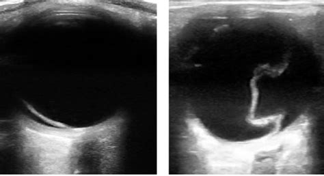 Retinal Detachment Ultrasound