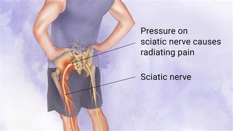 Sciatica Surgery or Chiropractic? - Hometown Family Wellness Center