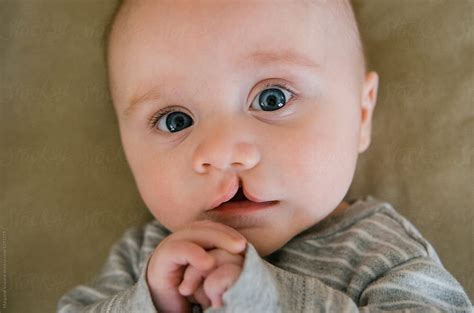 All about Cleft Lip and Palate: What You Should Expect and Know