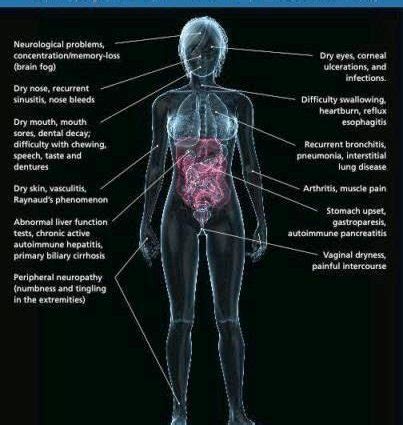 Dry mouth – the most common causes, home remedies, Sjogren’s syndrome ...