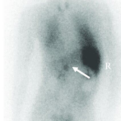 Figure3. 123 I-MIBG scintigraphy. The white arrow indicates the adrenal... | Download Scientific ...