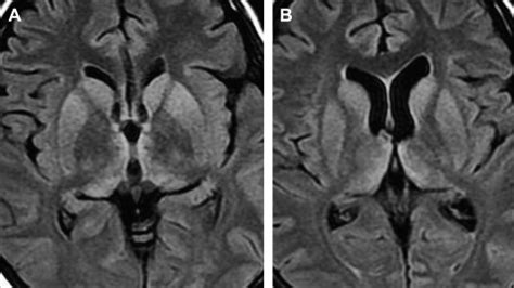 Prion Infections of the Brain | Radiology Key