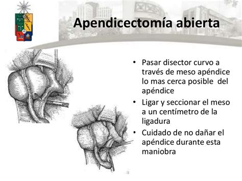 Apendicectomía abierta y vlp