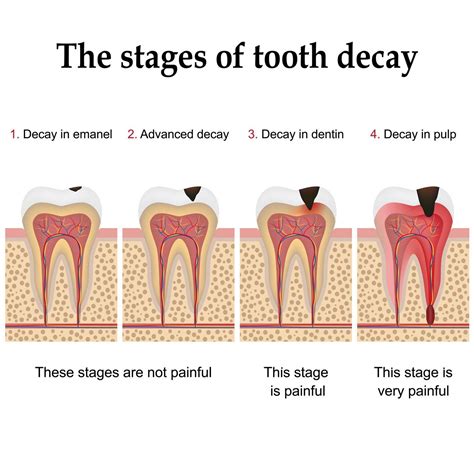 Stages of Tooth Decay | Cedar Creek Dental