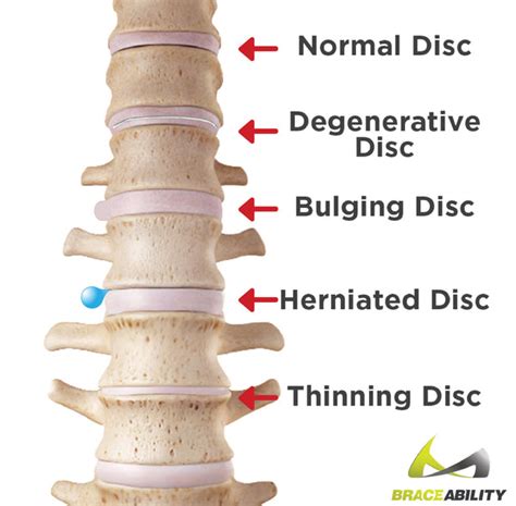 Bulging Disc Treatment of the Neck, Upper, & Lower Back