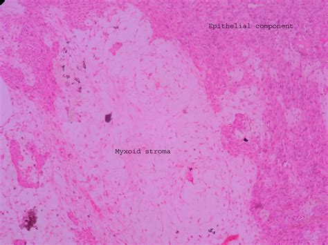 Pleomorphic adenoma – Histopathology.guru