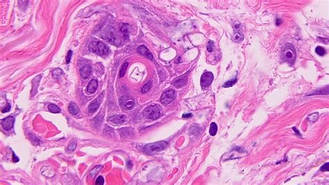 Mucormycosis Histology