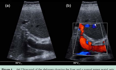 Figure 4 from Portal vein thrombosis. | Semantic Scholar