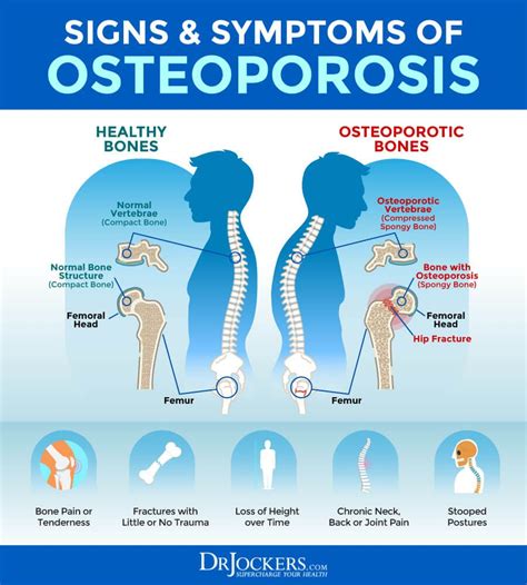 Osteoporosis: Symptoms, Causes and Natural Support Strategies Femur Bone, Hip Fracture, Weight ...