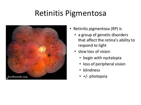 RETINITIS PIGMENTOSA | MALALTIES GENÈTIQUES