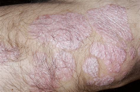 Psoriasis on a man's elbow - Stock Image - M240/0606 - Science Photo Library