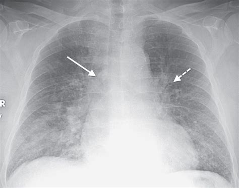 Interstitial Pneumonia X Ray