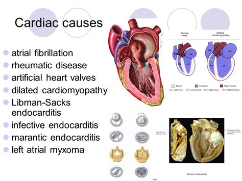 Ischemic cardiomyopathy treatment