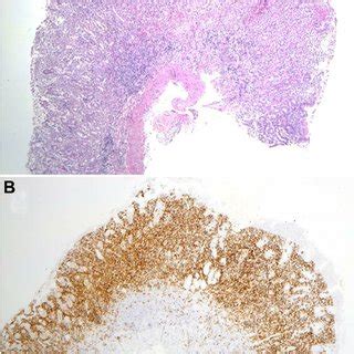 Mucosal biopsy findings. (A) Biopsy of the gastric antrum shows diffuse... | Download Scientific ...