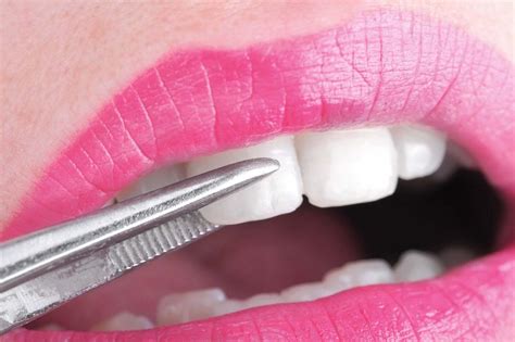 5 Types of Veneer Teeth That Can Transform Your Smile - AnnMarie John