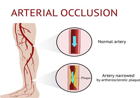 CE Activity | Acute Arterial Occlusion | Nurses