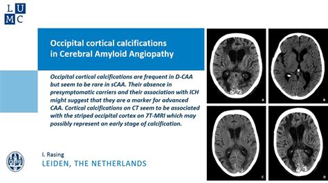 Symptoms Of Brain Calcification