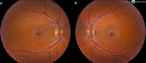 Idiopathic Juxtafoveal Retinal Telangiectasis