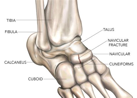 Navicular Stress Fracture Top Of Foot